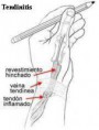 /album/fotogaleria/tendinitis-jpg/