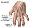 /album/fotogaleria/osteoartritis-jpg/
