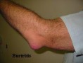 /album/fotogaleria/burtritis-jpg/