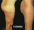 /album/fotogaleria/celulitis-jpg/
